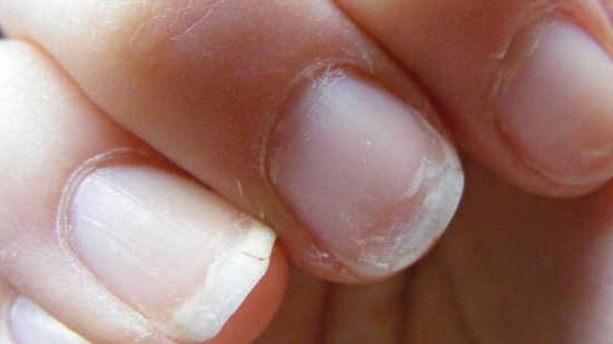 guisante Ambicioso para mi Las características en las uñas pueden hablarnos de enfermedad
